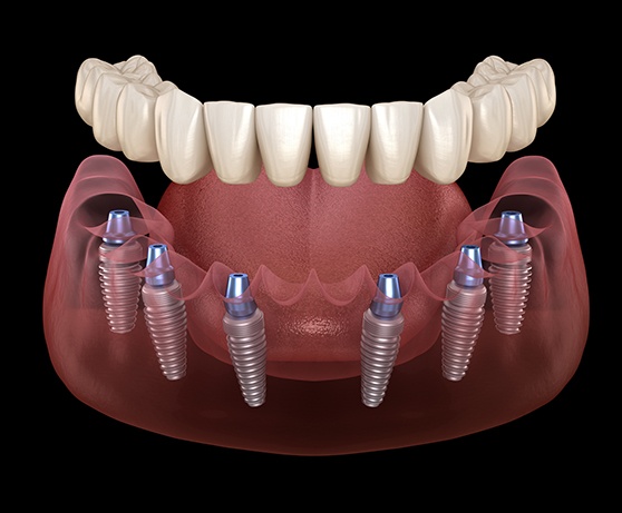 Digital illustration of implant dentures
