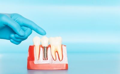 Blue gloved hand pointing to sample dental implant