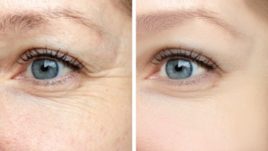 A woman’s crow’s feet before and after BOTOX injections
